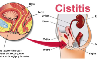 cistitis