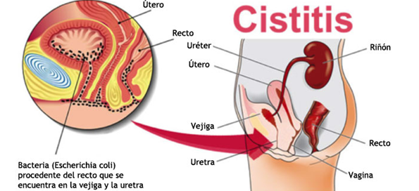 cistitis