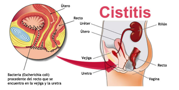 cistitis