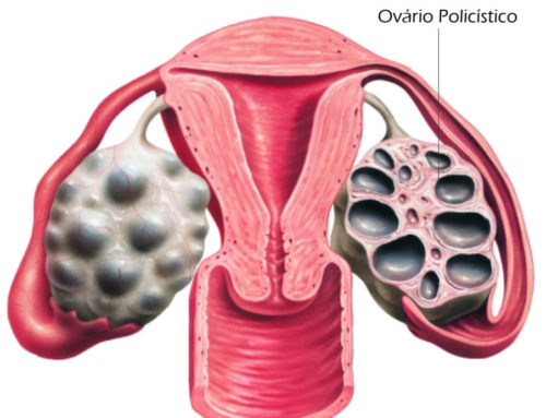 Ovario Poliquístico